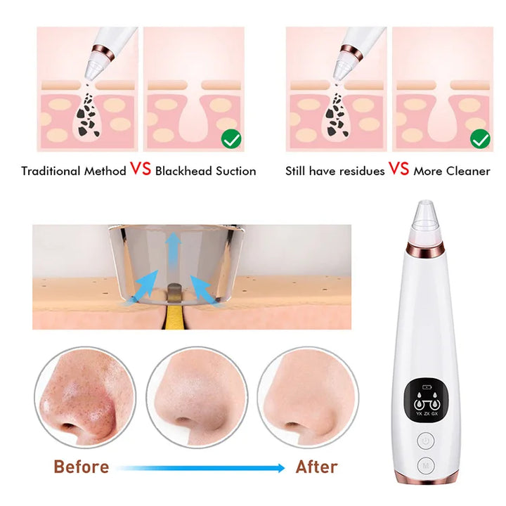 Portable Vacuum Blackhead Remover