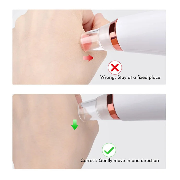 Portable Vacuum Blackhead Remover